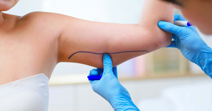 Body Lift & Skin Tightening